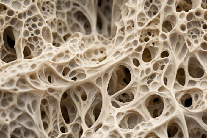 Que es la osteoporosis, y qué la causa? cómo se puede prevenir?