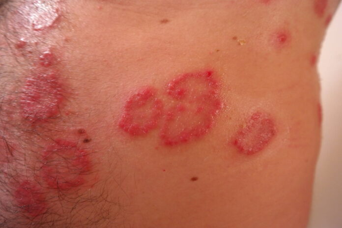 La psoriasis es una enfermedad de la piel que causa descamación e inflamación (dolor, hinchazón, calentamiento y coloración).