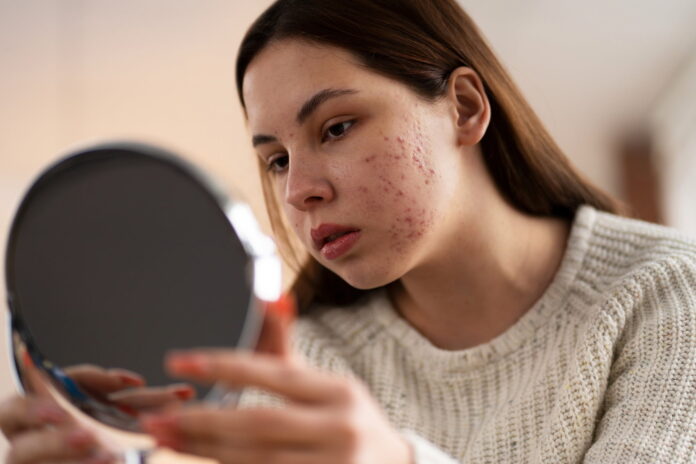 Descubre cómo manejar el acné hormonal naturalmente a cualquier edad con estrategias holísticas que abordan la raíz del problema y promueven una piel saludable.
