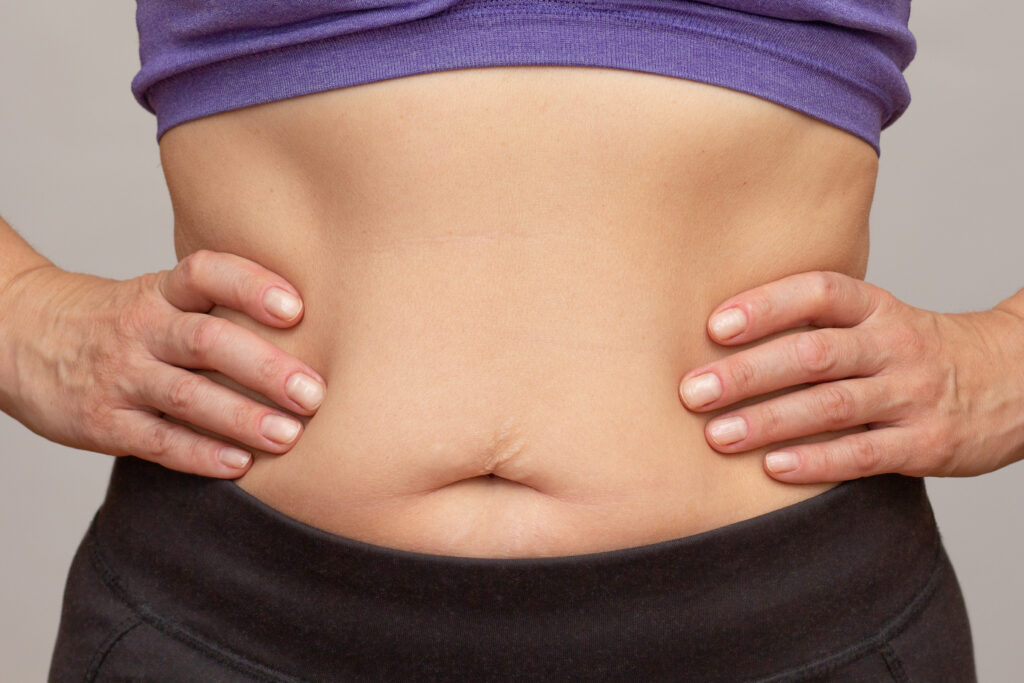 Primer plano del abdomen de una persona; la grasa abdominal se asocia con la resistencia a la insulina.